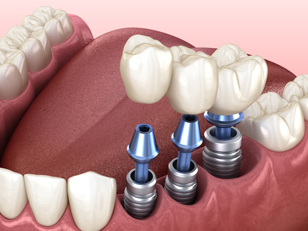 illustration of dental implants in mouth Jasper, AL dental implants